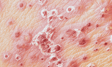 First-ever herpes-based therapy to treat severe skin cancer could soon be approved
