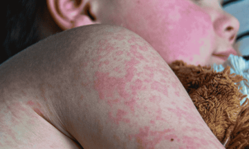 US measles outbreak worst since disease declared eliminated